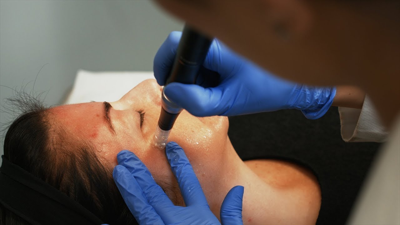 Microneedling Treatment - Courtesy of Ileana Perez-Quintairos, MD, Board Certified Dermatologist