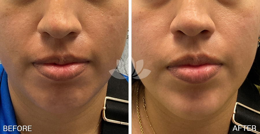 Patient treated with filler and neuromodulators on the chin by a dermatologist in South Miami FL.