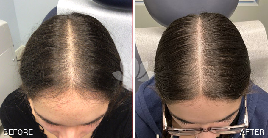 Female patient treated for hair loss by dermatologist in South Miami FL.
