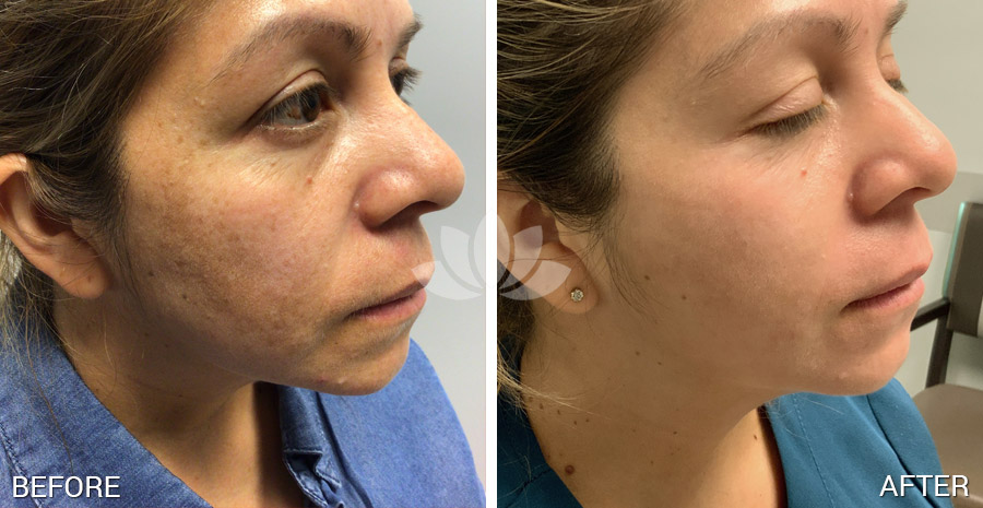 Patient treated for melasma on the cheeks.