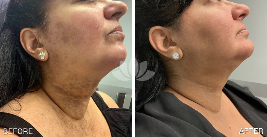 Female patient treated with PicoWay by Dr. Perez-Quintairos, dermatologist in South Miami, FL.