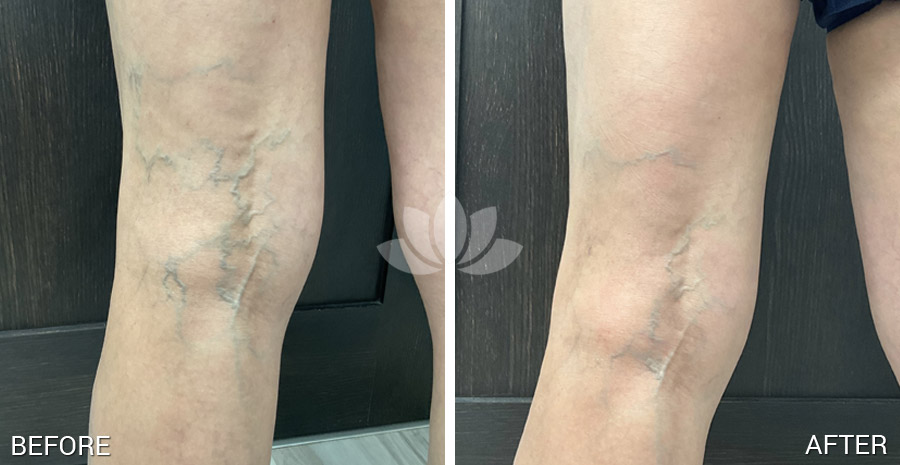 Sclerotherapy treatment by dermatologist in South Miami.
