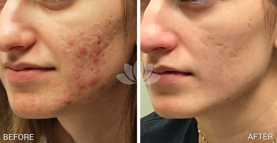 Woman treated for acne with multiple VBeam laser sessions & topical acne treatments.
