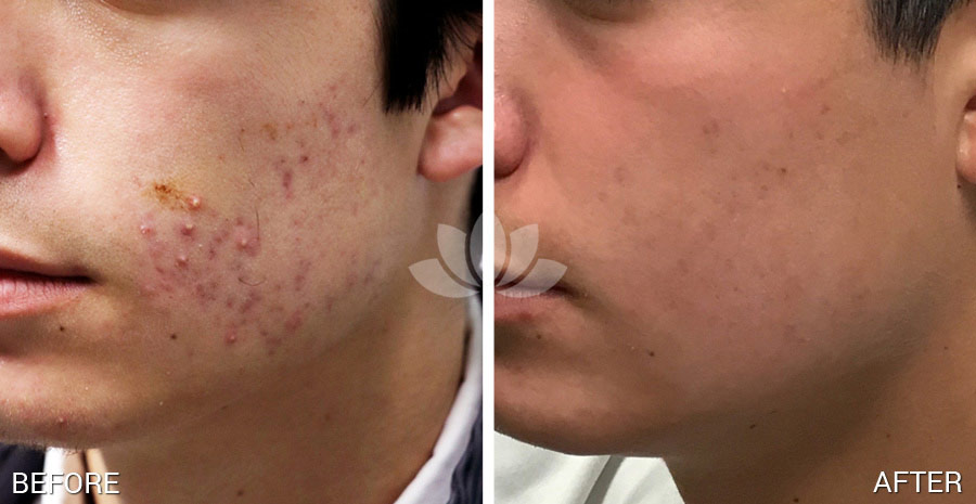 Man treated for acne with topical and oral medications at Sunset Dermatology.