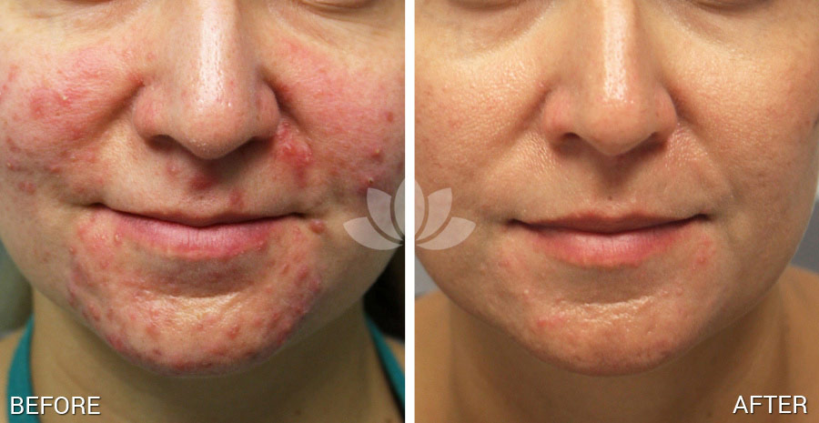 Woman treated for acne at Sunset Dermatology.