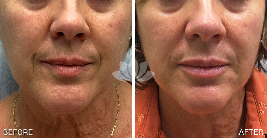 This patient had 1 mL of Restylane Refyne to nasolabial folds and Restylane Kysse performed to lips.