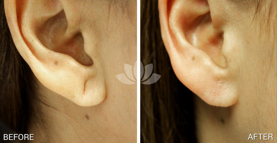 Ear repair surgery performed in a woman.