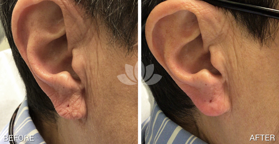 Patient had filler performed to her ear lobes with Restylane by a dermatologist in South Miami, FL.
