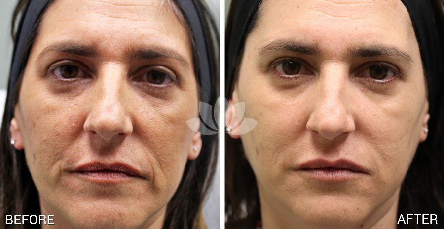 Woman treated with multiple cosmetic procedures in South Miami.