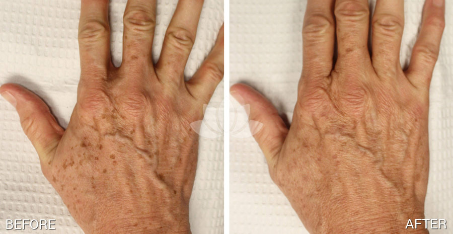 Hand of woman treated with Intense Pulse Light (IPL) in Sunset Dermatology.