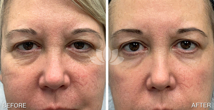 Woman with Facial telangiectasia treated with IPL at Sunset Dermatology.