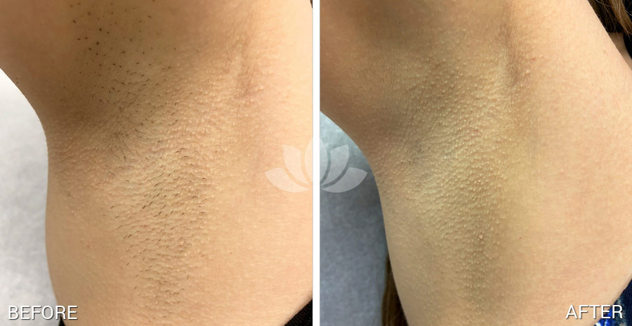 Woman in South Miami treated with laser hair removal.