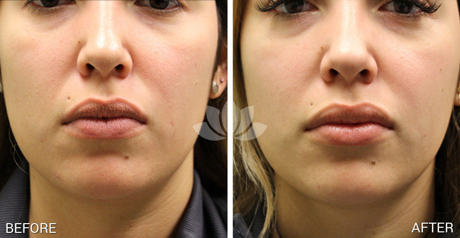 Lip augmentation performed in a woman at Sunset Dermatology.