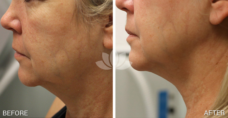 Woman treated with Profound at Sunset Dermatology.