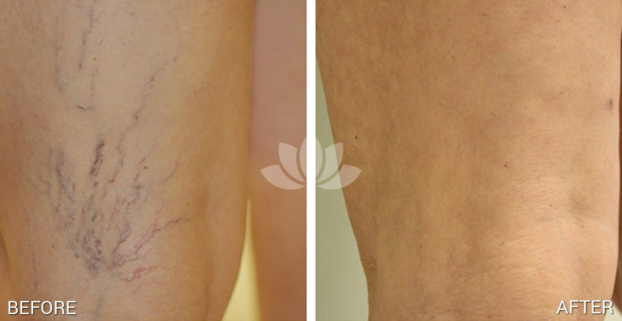 Woman treated with sclerotheraphy using Asclera at Sunset Dermatology.