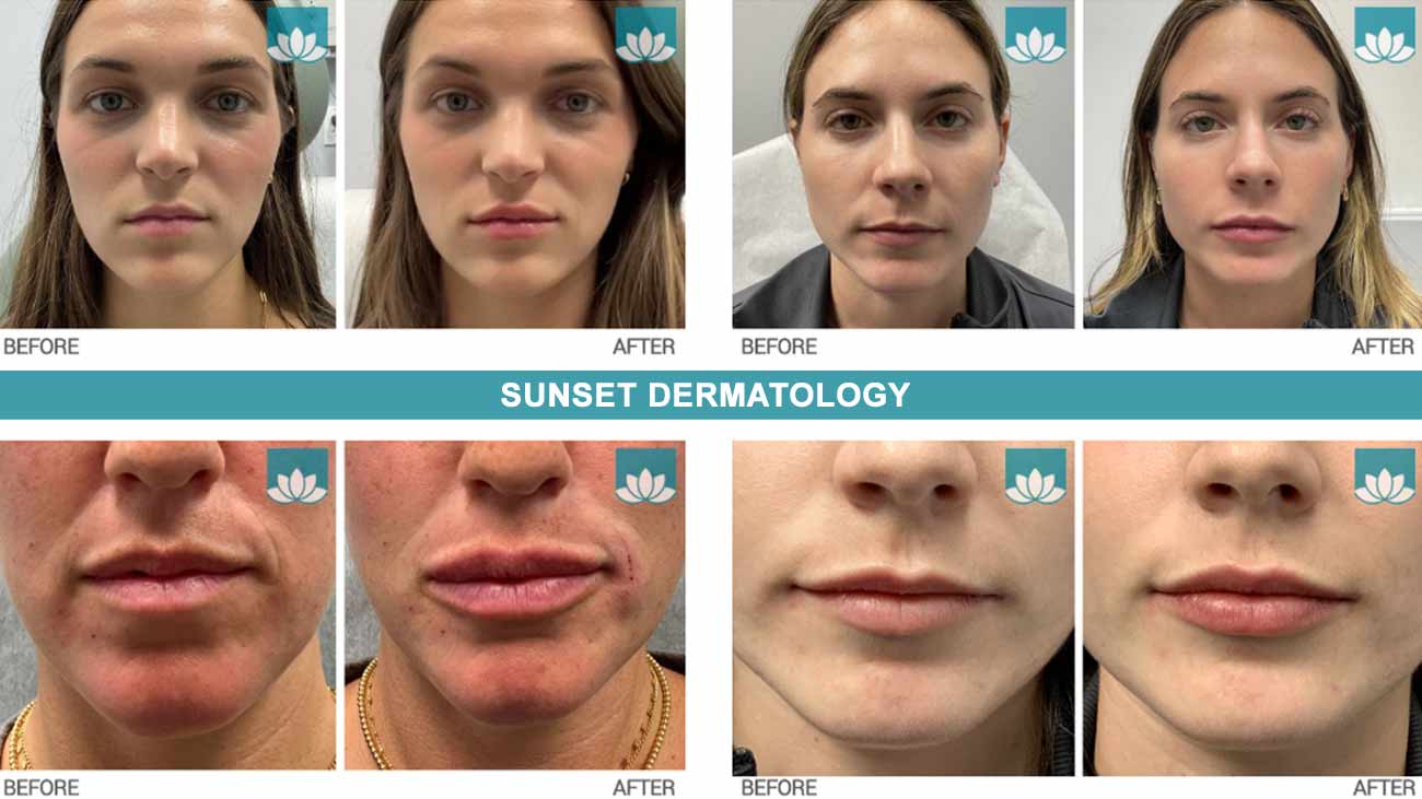 Lip Augmentation in South Miami
