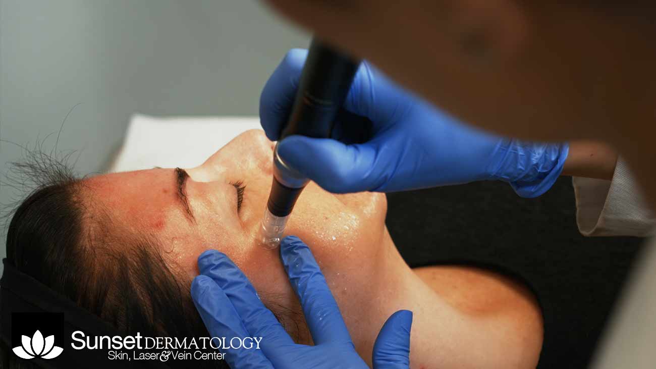 Microneedling in South Miami
